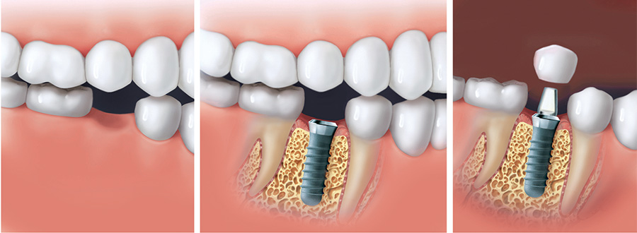 Festsitzende, implantatgetragene Zähne sehen nicht nur aus wie eigene, sondern fühlen sich auch so an.