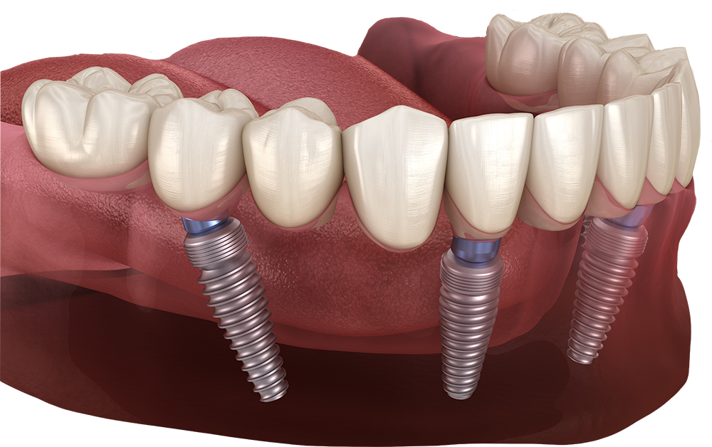 sofortversorgung pro arch